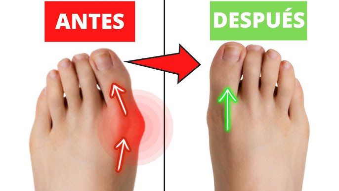 Bunion Corrector Blue™- ¡Recuperar Tu Paso Firme!- (Liquidación por cierre)